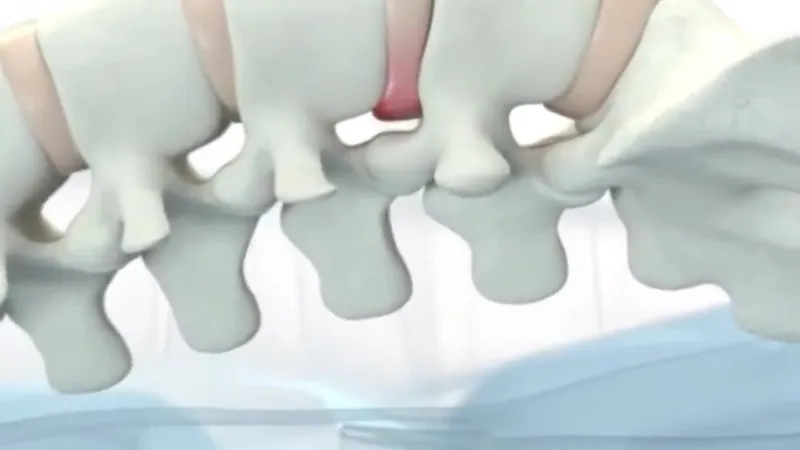 Vista 3D anatómica de columna vertebral mostrando una hernia discal (segmento rojo) entre las vértebras, base biomecánica del tratamiento SDV